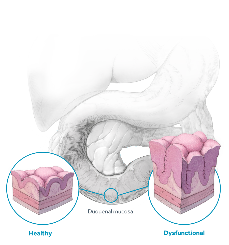 Healthy - Dysfunctional Gut